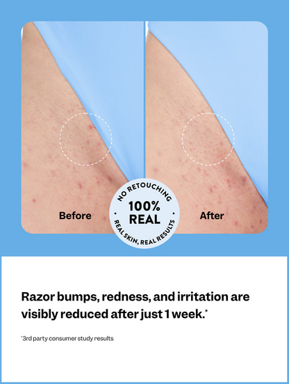 Smoothing Solution Ingrown Hair Treatment